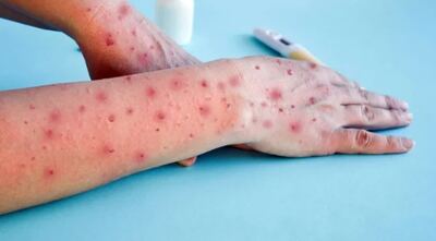 Se registró el primer caso autóctono de viruela del mono en el país